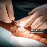 Applying steri strips to a man's wrist two weeks after carpal tunnel surgery
