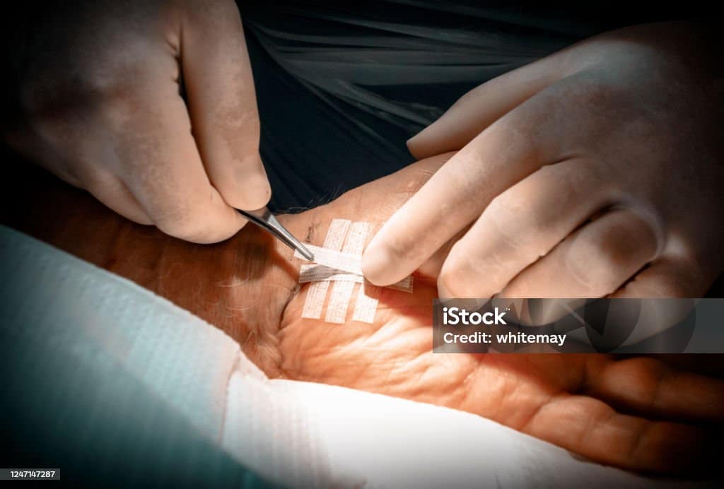 Taking Care of Your Steri-Strips Taking Care of Your Steri-Strips